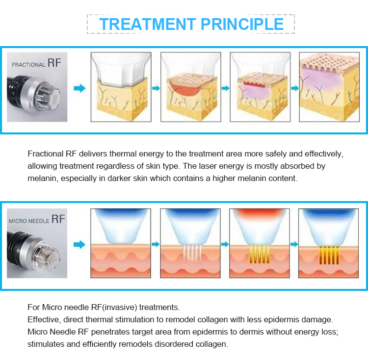 Micro needling RF acne scar removal skin rejuvenation