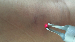 vascular spider vein removal diode laser 980 nm (3)